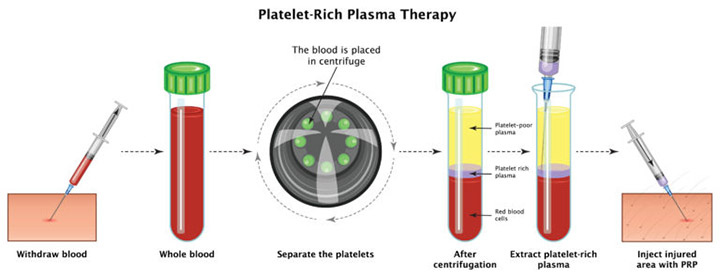 PRP Therapy